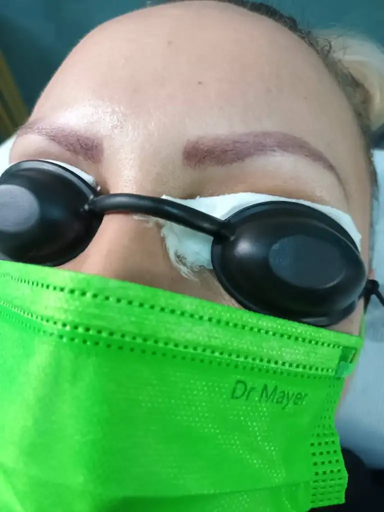 Protecție oculară în timpul procedurii laser